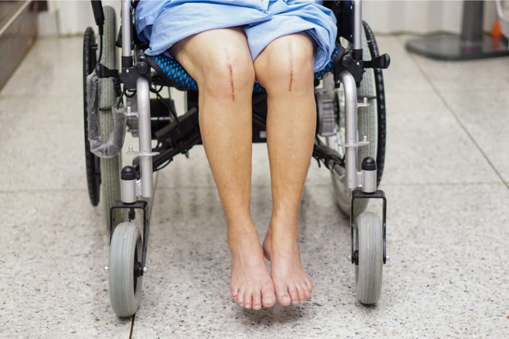 Patient in a wheelchair showing surgical scars on both knees after knee replacement surgery in a hospital setting