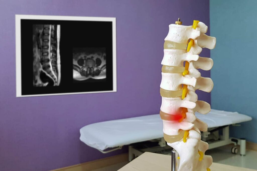 Spinal column anatomical model showing a herniated disc injury with MRI scans displayed on a medical exam room wall