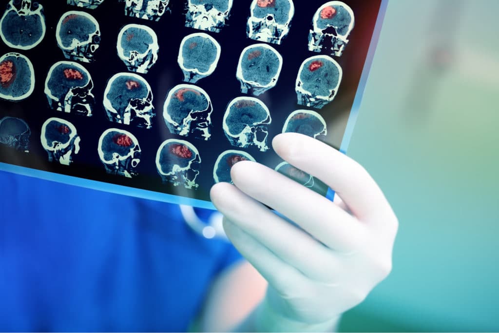 Medical professional in gloves reviewing brain CT scan images showing highlighted areas of traumatic brain injury